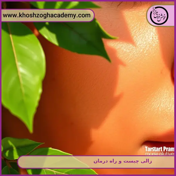 زالی چیست و راه درمان زالی چیست